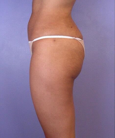 Liposuction Before & After Image