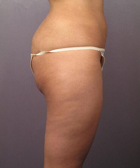 Liposuction Before & After Image