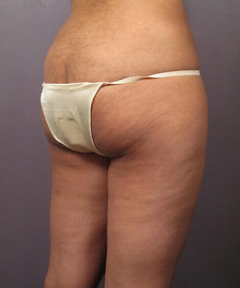 Liposuction Before & After Image