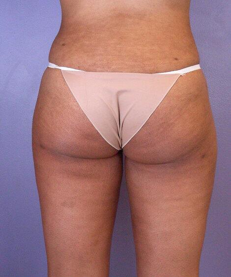 Liposuction Before & After Image