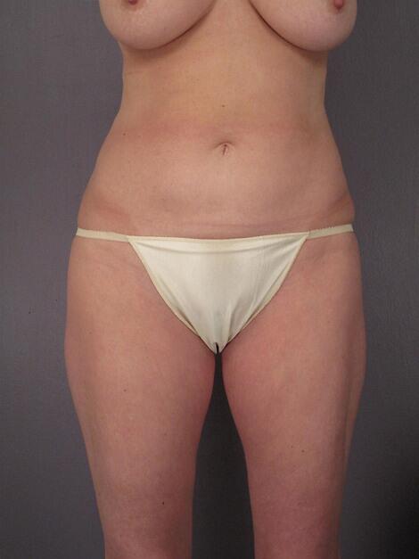 Liposuction Before & After Image