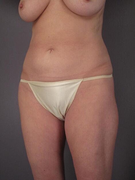 Liposuction Before & After Image