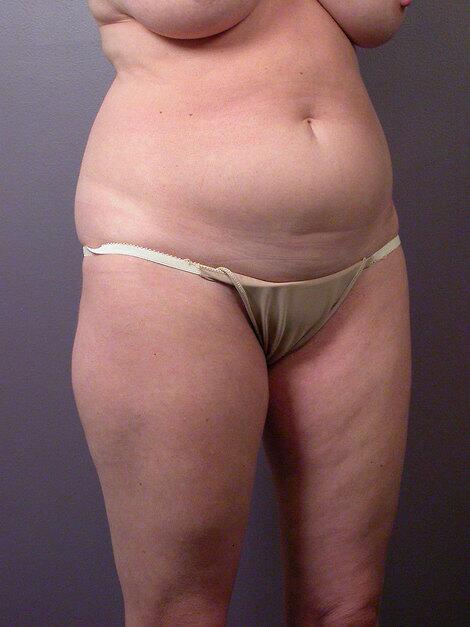 Liposuction Before & After Image