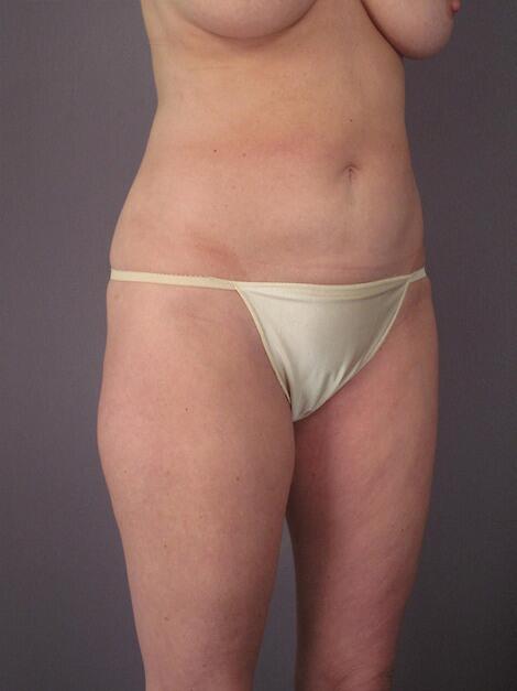 Liposuction Before & After Image