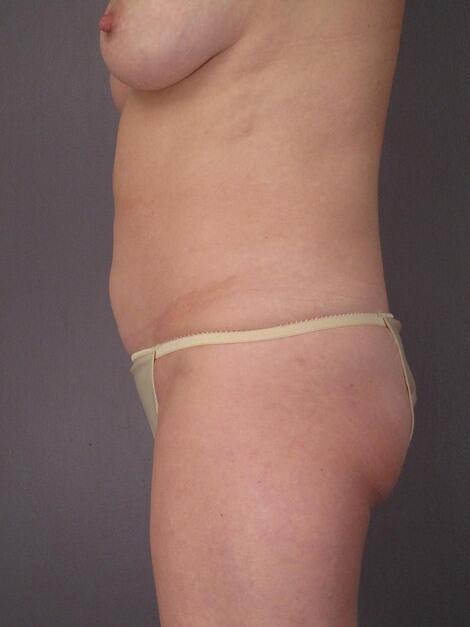 Liposuction Before & After Image