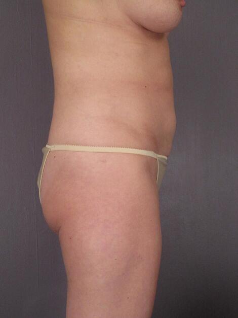 Liposuction Before & After Image