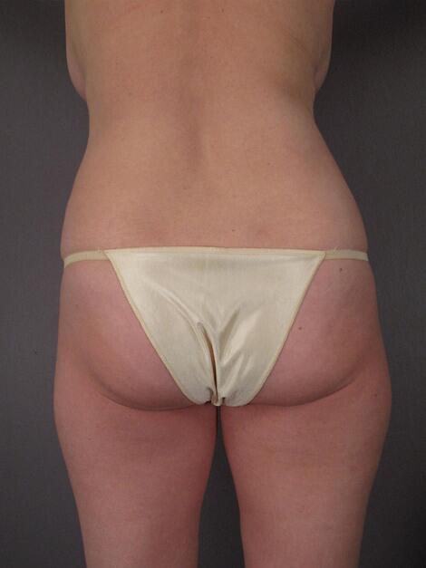 Liposuction Before & After Image