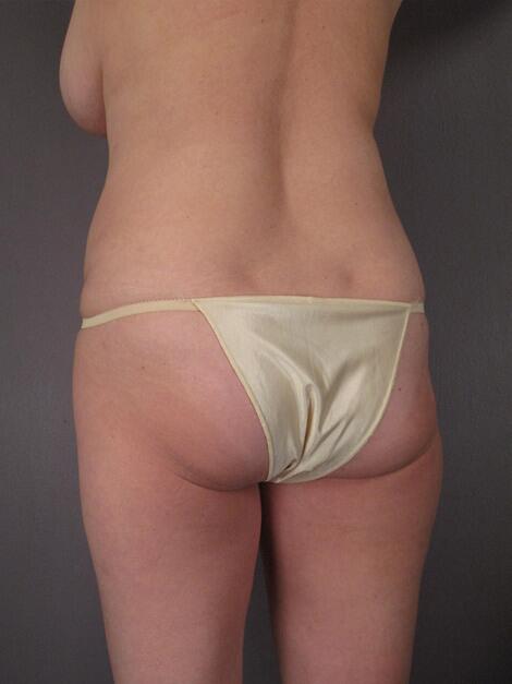 Liposuction Before & After Image