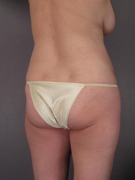 Liposuction Before & After Image