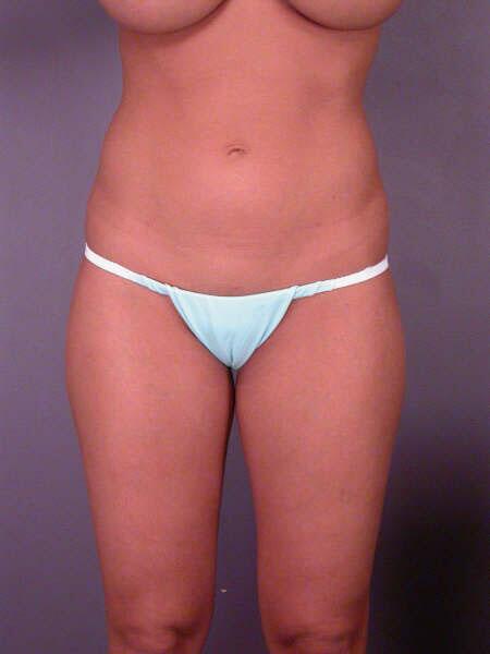 Liposuction Before & After Image