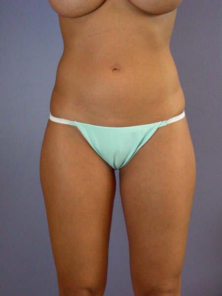 Liposuction Before & After Image