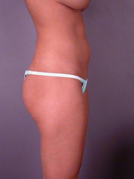 Liposuction Before & After Image