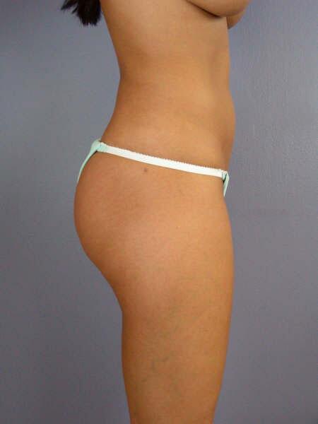 Liposuction Before & After Image