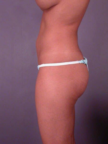 Liposuction Before & After Image