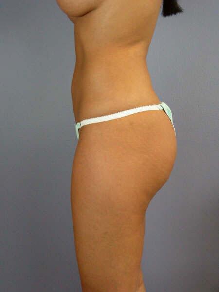 Liposuction Before & After Image