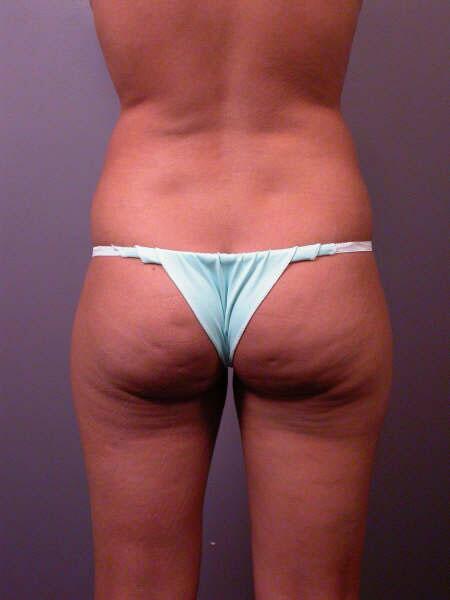 Liposuction Before & After Image