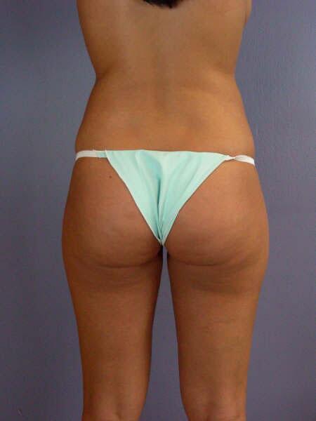 Liposuction Before & After Image