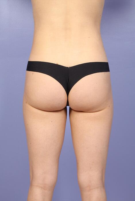 Liposuction Before & After Image