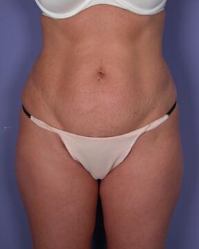 Liposuction Before & After Image