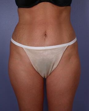 Liposuction Before & After Image