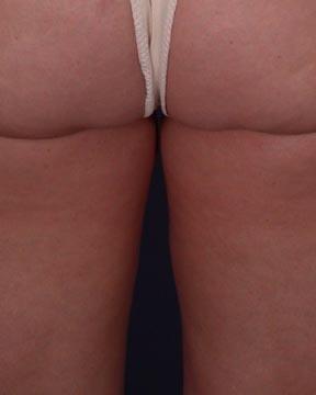 Liposuction Before & After Image