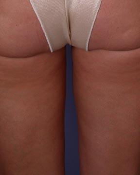 Liposuction Before & After Image