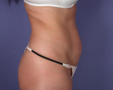 Liposuction Before & After Image