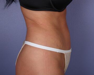 Liposuction Before & After Image