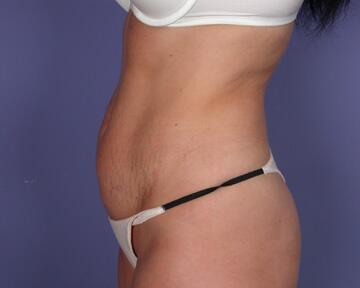 Liposuction Before & After Image