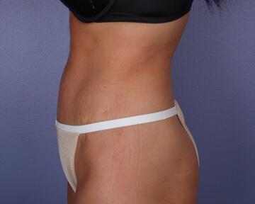 Liposuction Before & After Image