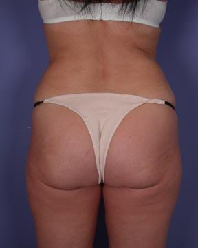 Liposuction Before & After Image