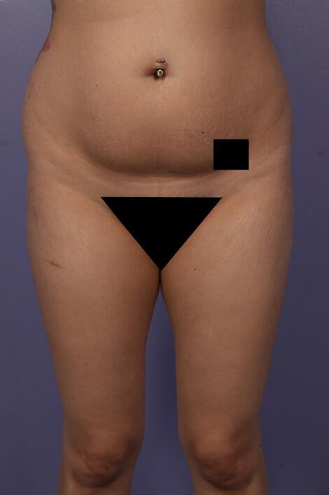 Liposuction Before & After Image