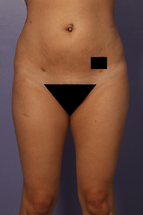 Liposuction Before & After Image