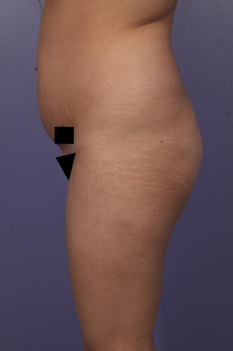 Liposuction Before & After Image