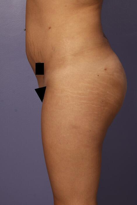 Liposuction Before & After Image