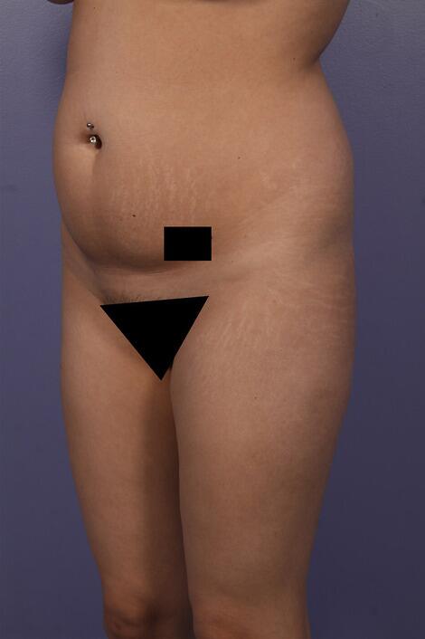 Liposuction Before & After Image