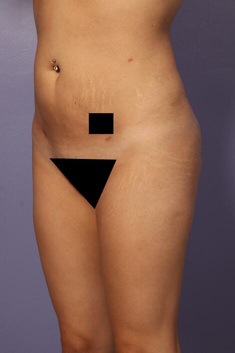 Liposuction Before & After Image