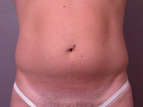 Liposuction Before & After Image