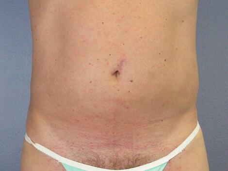 Liposuction Before & After Image