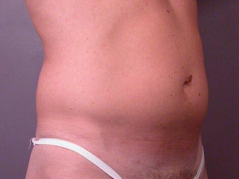 Liposuction Before & After Image