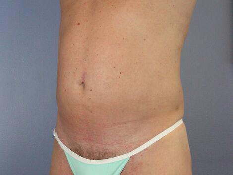 Liposuction Before & After Image