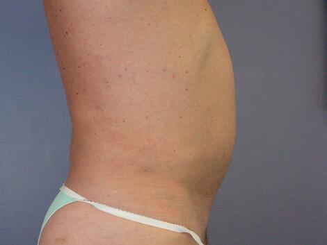 Liposuction Before & After Image