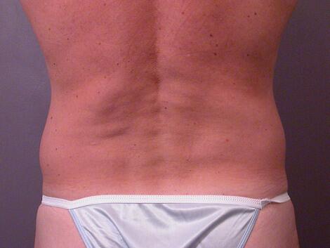 Liposuction Before & After Image