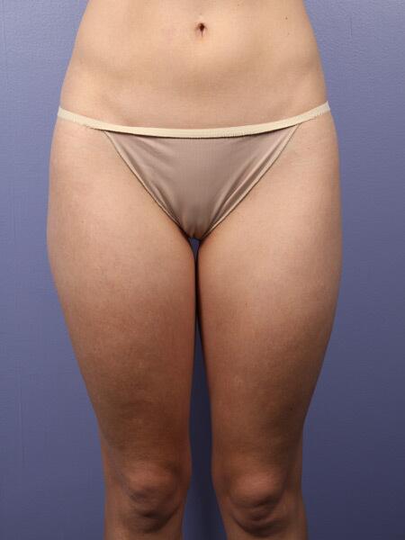 Liposuction Before & After Image