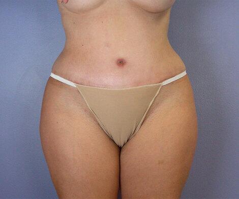 Liposuction Before & After Image