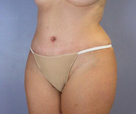 Liposuction Before & After Image