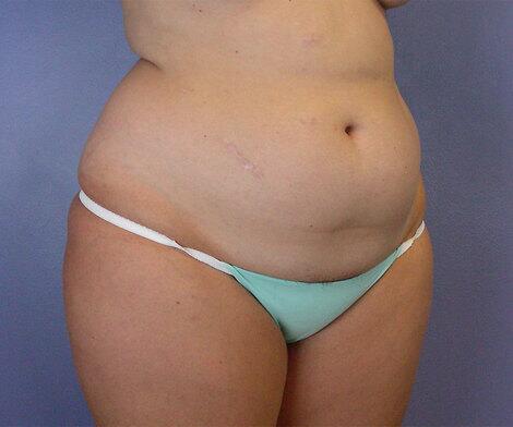 Liposuction Before & After Image