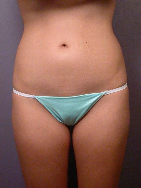 Liposuction Before & After Image