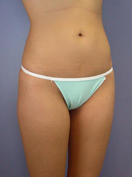 Liposuction Before & After Image