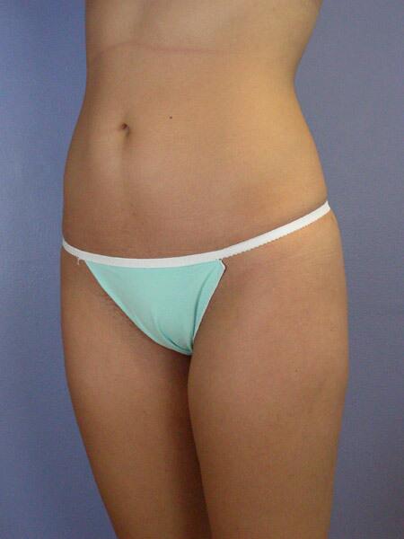 Liposuction Before & After Image